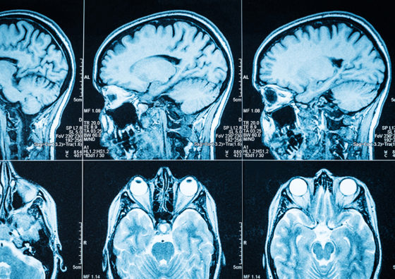 brain scans